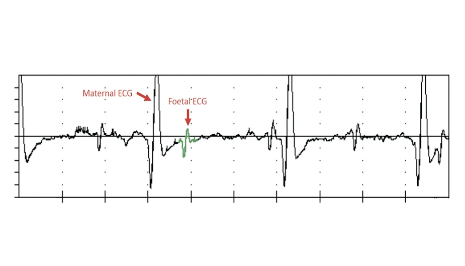 Ai Ecg Edit A