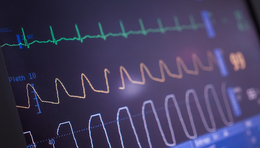 Ecg